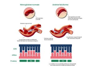 Deux types d’allèles du gène codant pour l’hémoglobine. L’un de ses allèles crée un globule rouge anormal en forme de faucille, bloquant ainsi les vaisseaux sanguins. Les personnes présentant ce phénotype sont touchées par l’anémie falciforme.